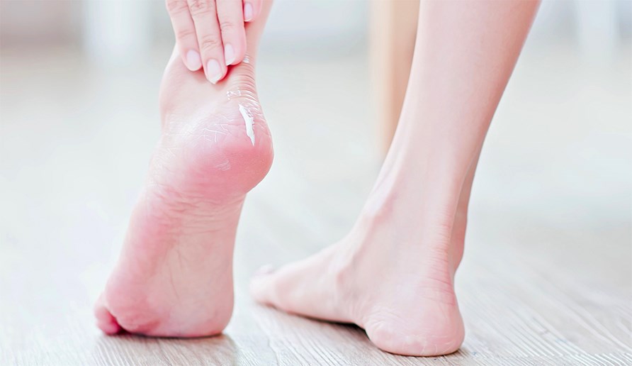 Ksi levitt jalkavoidetta kuiviin jalkoihin.